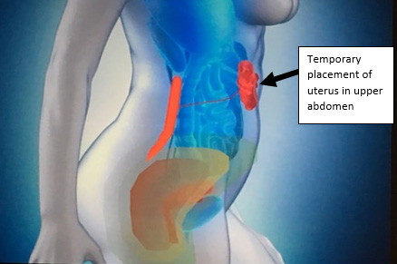 uterine transposition