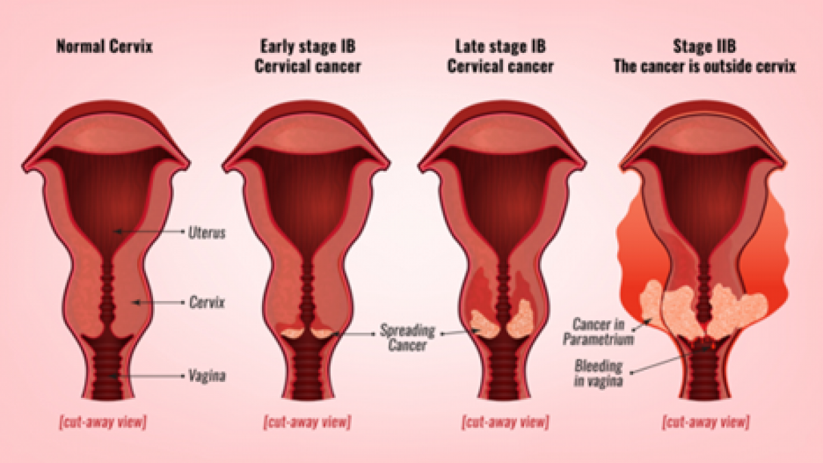 Is cervical cancer curable Prof Andreas Obermair Professor