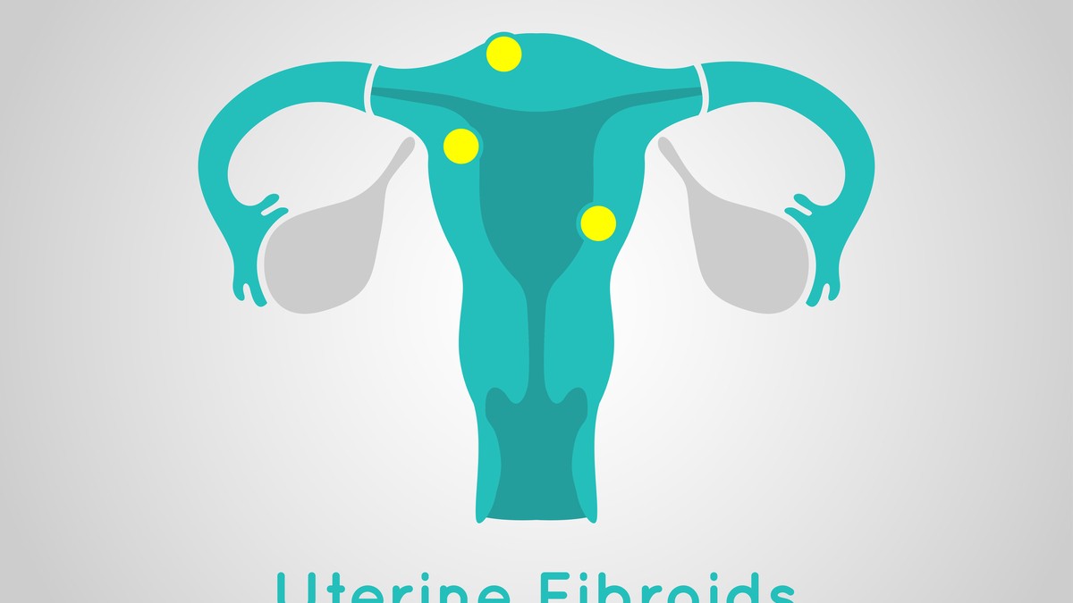 Uterine Fibroids after Menopause