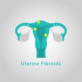 Illustration of a uterus depicting uterine fibroids