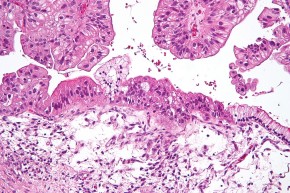 ovarian tumour cells under a microscope