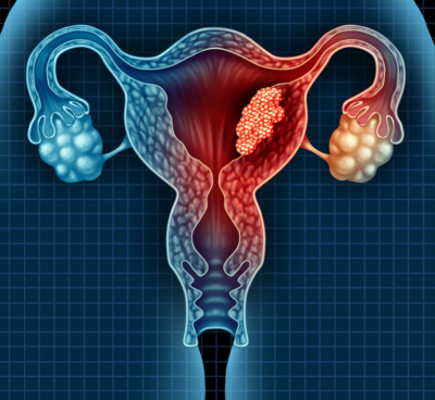 uterus with abnormal cells